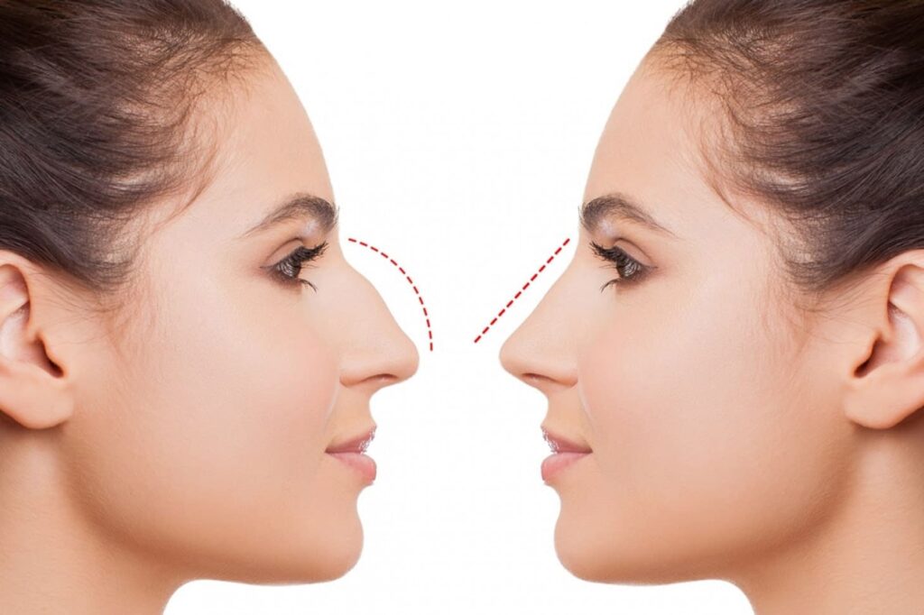 Rhinoplasty Tursium Health Tourism Agency 